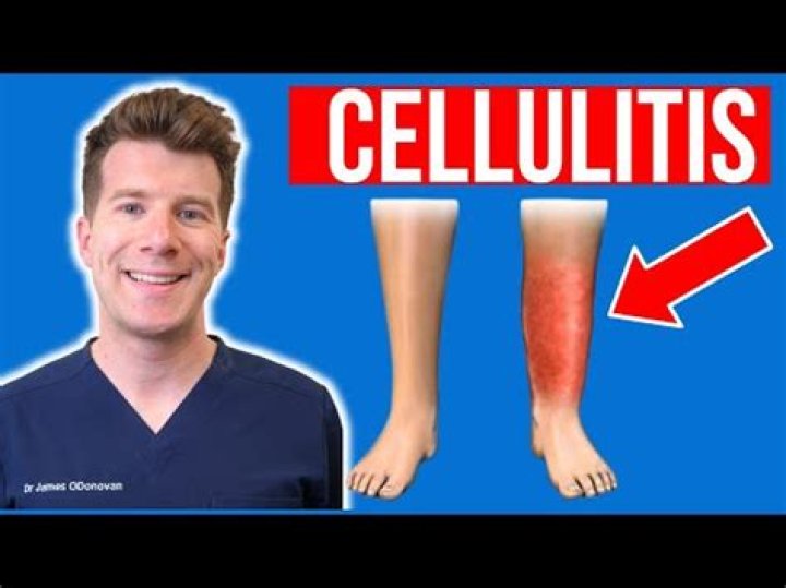 What are the signs that cellulitis is healing?