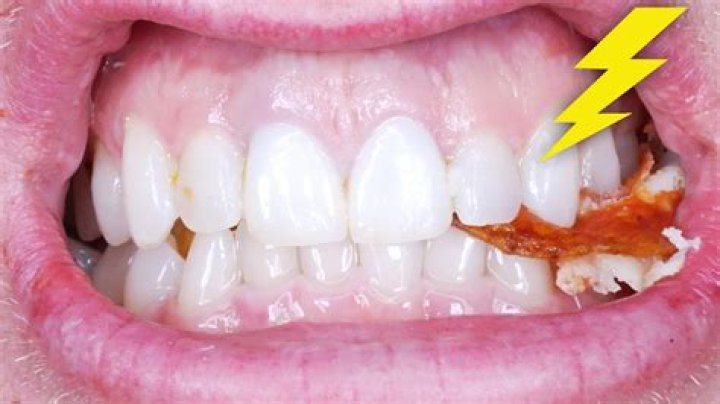 Why does my tooth hurt but no cavity?